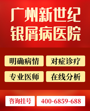 怎么预防男性牛皮癣复发