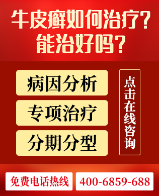 脓疱型牛皮癣有没有止痒的办法
