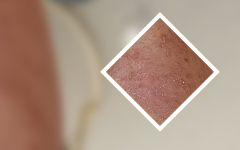 排行：广州治疗牛皮癣哪家医院是专业-寻常型银屑病的病因特点有哪些