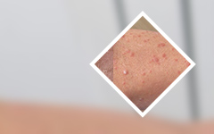 评选结果新出炉：广州看牛皮癣效果好医院-患者如何护理关节型牛皮癣